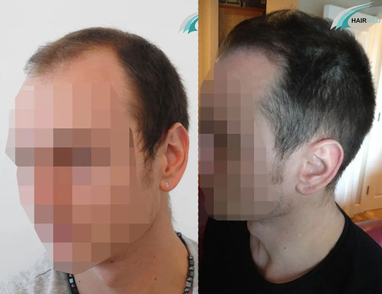 FUE — Dr Beyhan Zeybek Hair restoration expert