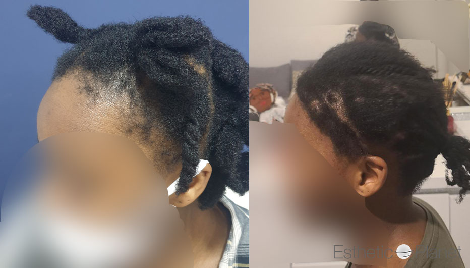 FUT — Dr Beyhan Zeybek Hair restoration expert