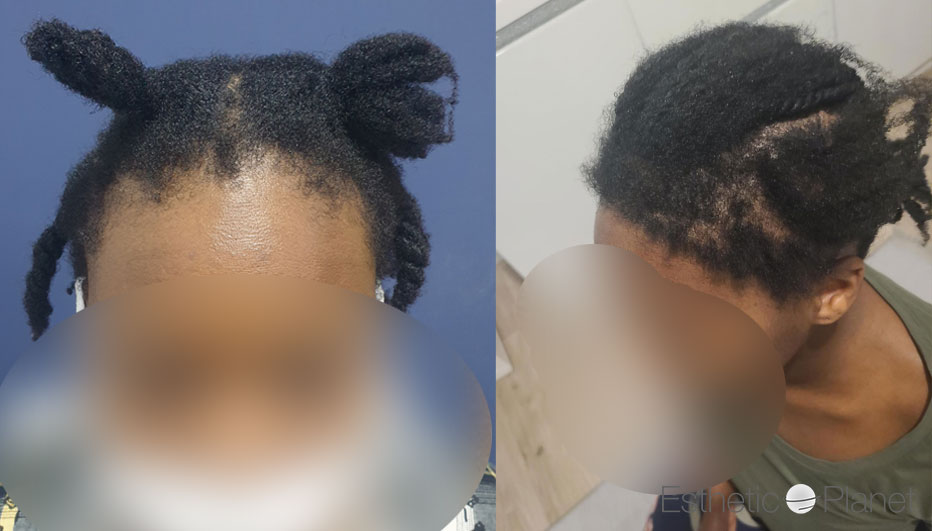 FUT — Dr Beyhan Zeybek Hair restoration expert