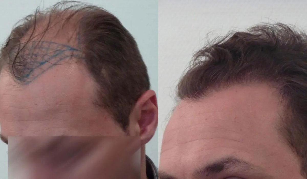 FUT — Dr Beyhan Zeybek Hair restoration expert