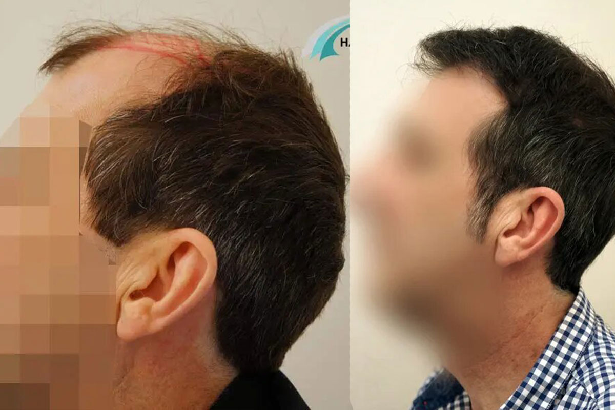 FUT — Dr Beyhan Zeybek Hair restoration expert