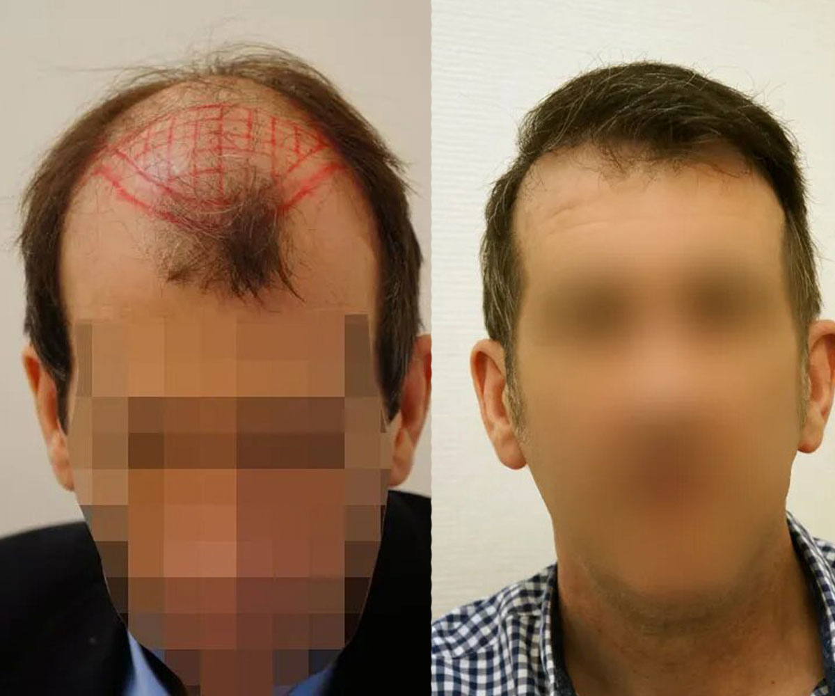 FUT — Dr Beyhan Zeybek Hair restoration expert