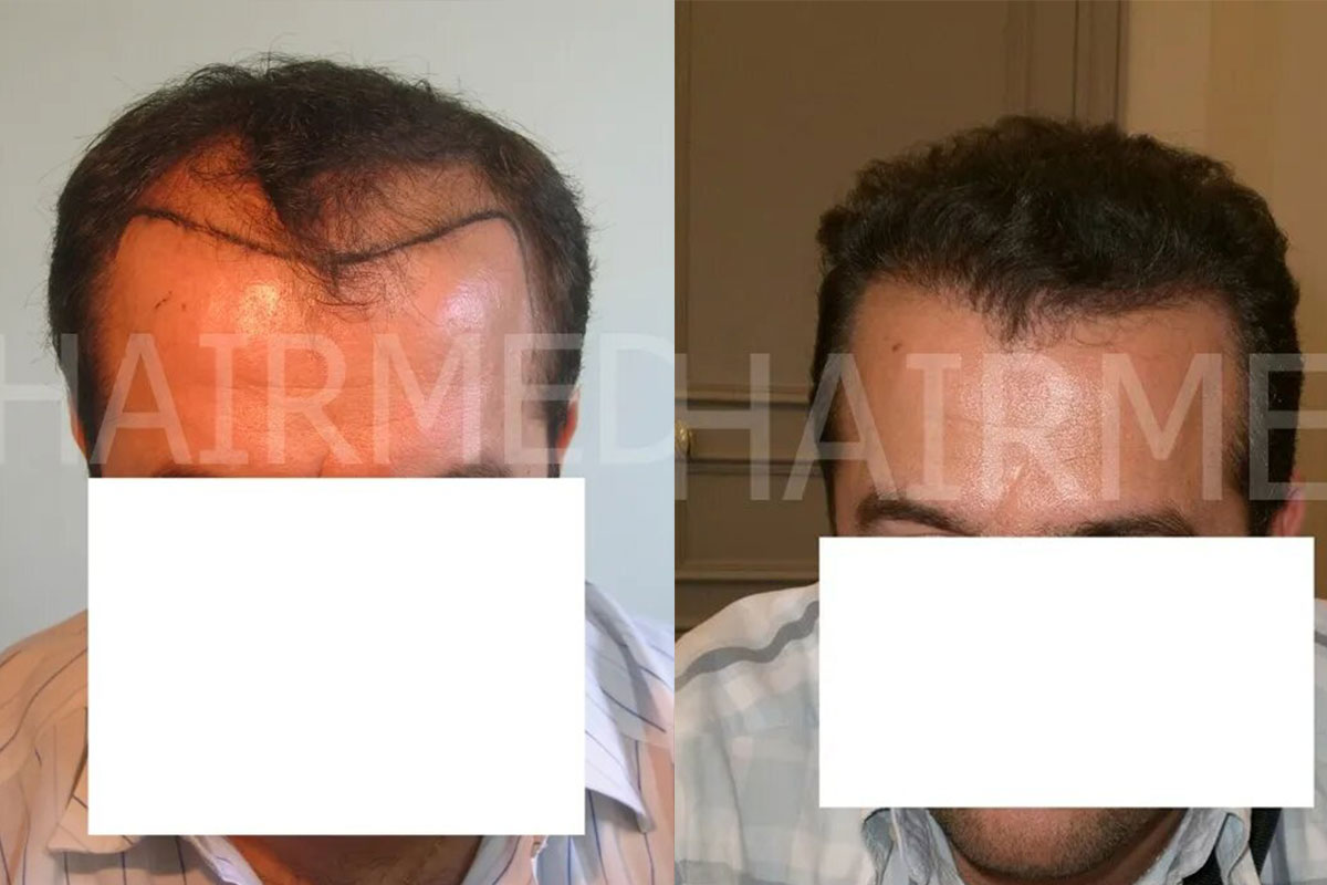 FUT — Dr Beyhan Zeybek Hair restoration expert