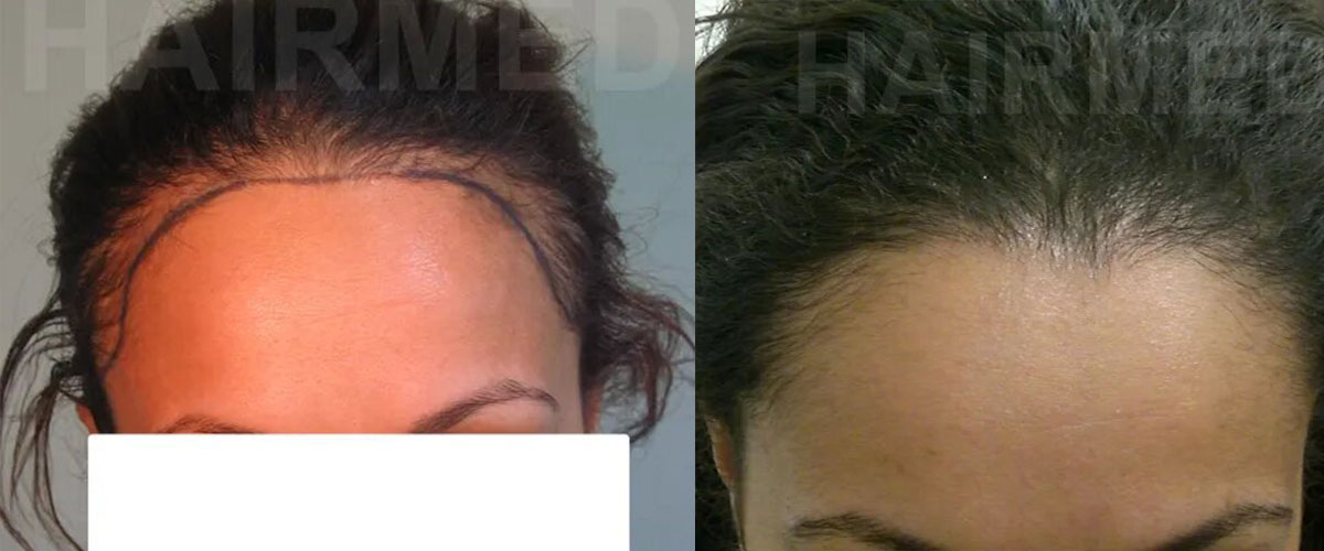 FUT — Dr Beyhan Zeybek Hair restoration expert