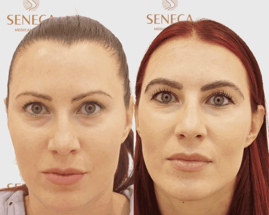 Eyebrow Transplant — Seneca Medical Group