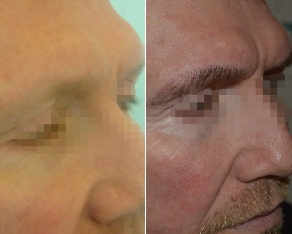 Eyebrow Transplant — Seneca Medical Group