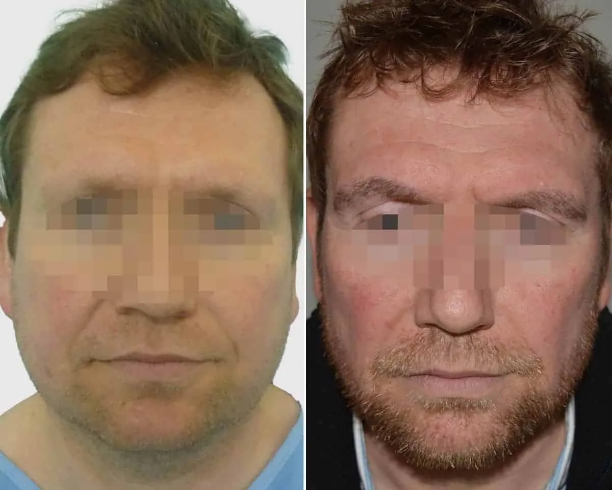Eyebrow Transplant — Seneca Medical Group