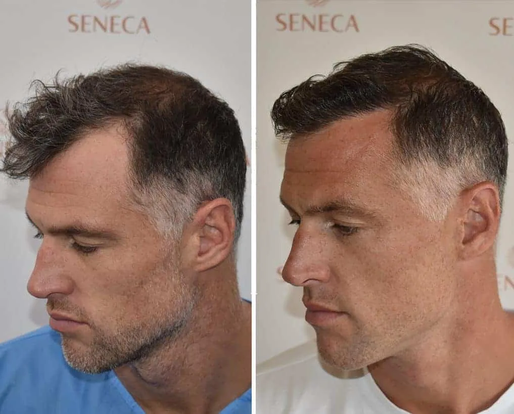 FUE by Doctor — Seneca Medical Group