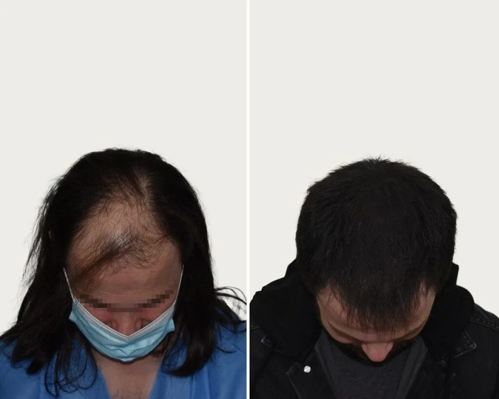 FUE by Doctor — Seneca Medical Group