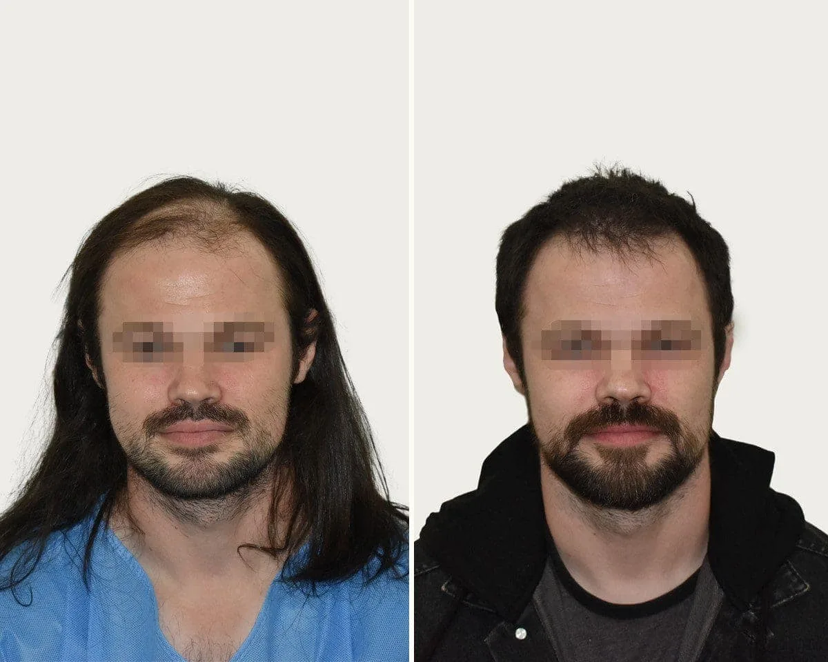 FUE by Doctor — Seneca Medical Group