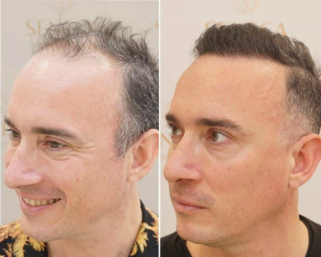FUE by Doctor — Seneca Medical Group
