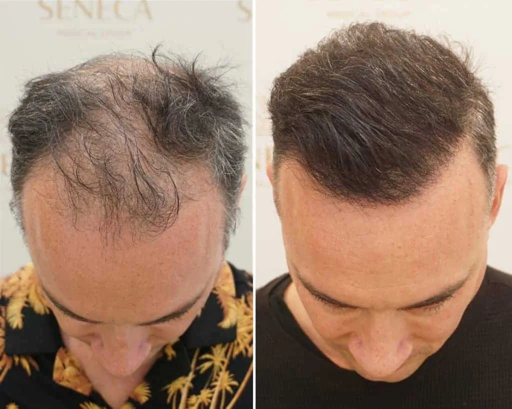 FUE by Doctor — Seneca Medical Group