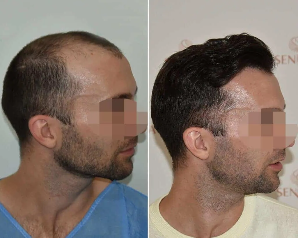 FUE by Doctor — Seneca Medical Group