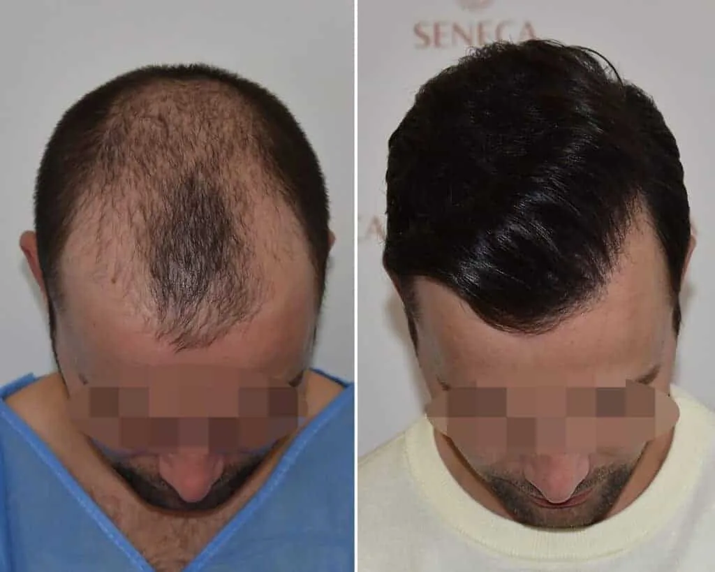 FUE by Doctor — Seneca Medical Group