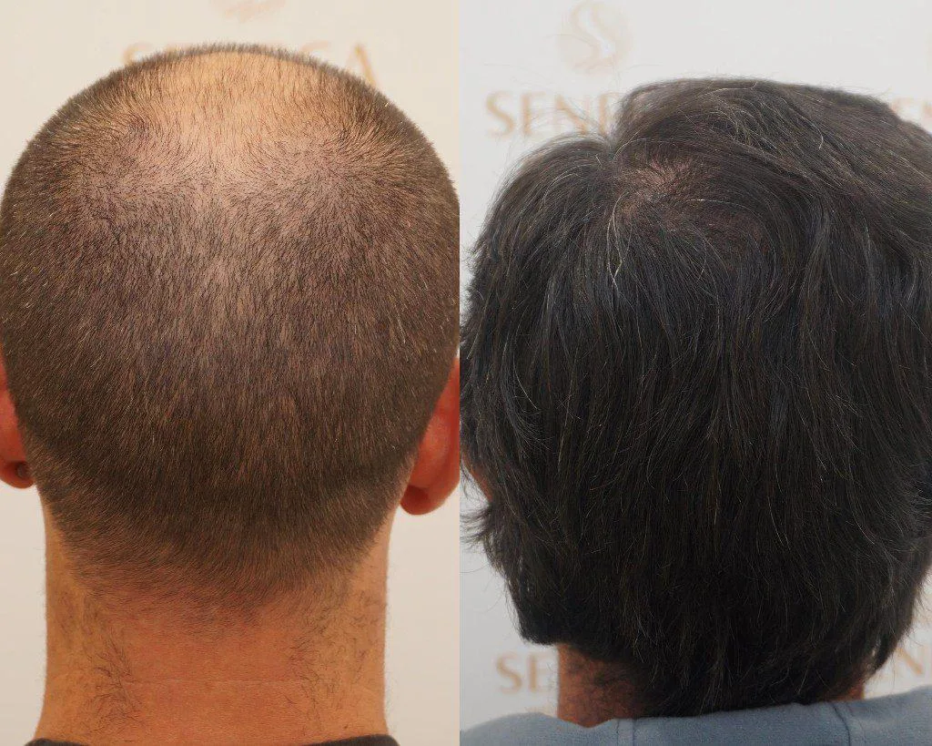 FUE by Doctor — Seneca Medical Group