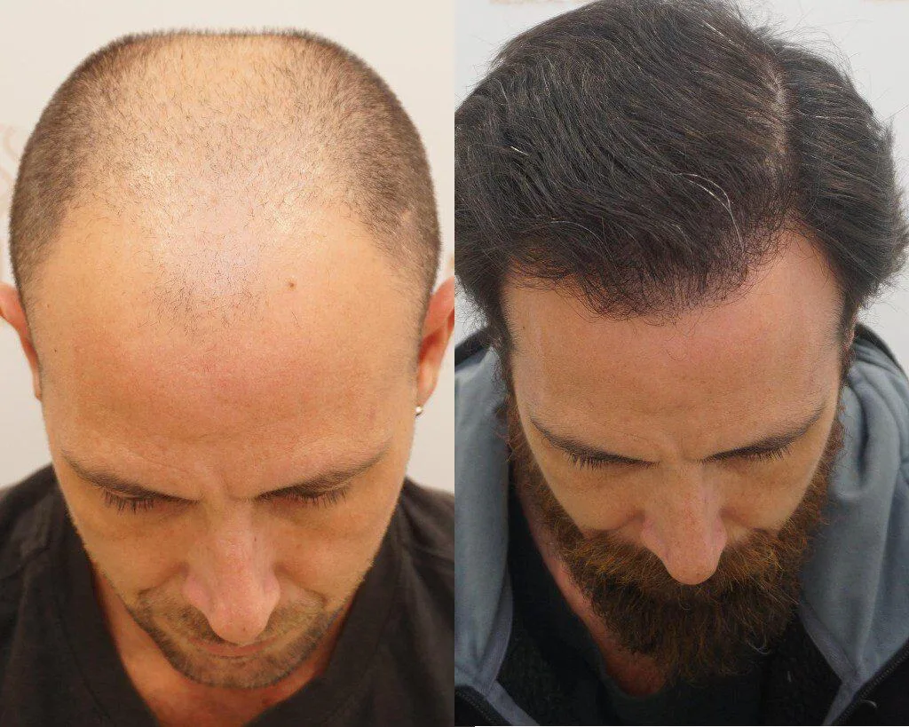 FUE by Doctor — Seneca Medical Group