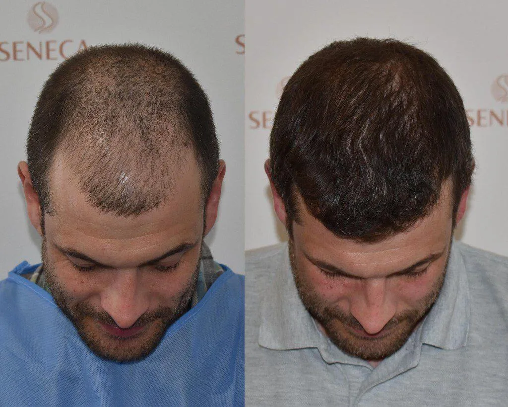 FUE by Doctor — Seneca Medical Group