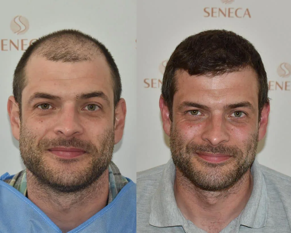 FUE by Doctor — Seneca Medical Group