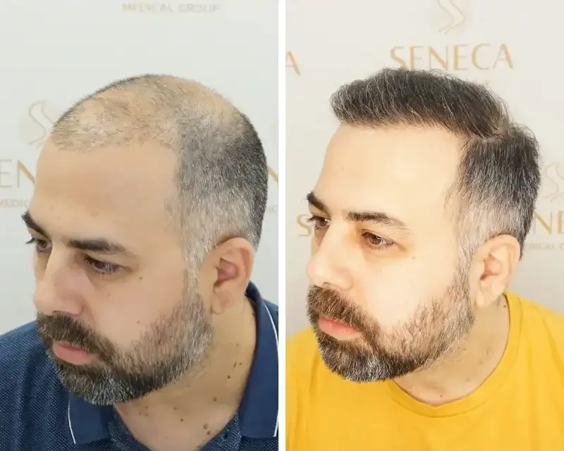 FUE by Doctor — Seneca Medical Group
