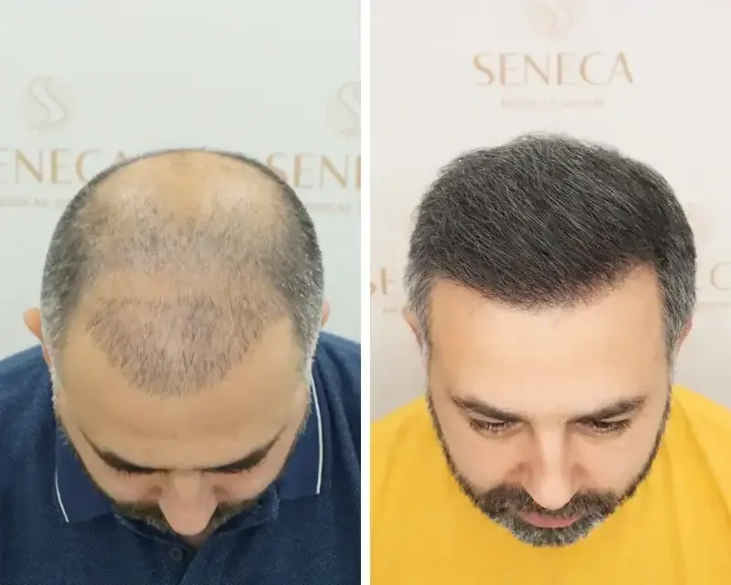 FUE by Doctor — Seneca Medical Group