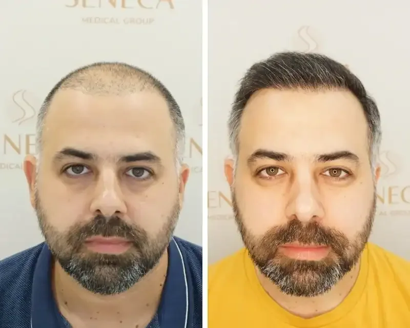 FUE by Doctor — Seneca Medical Group
