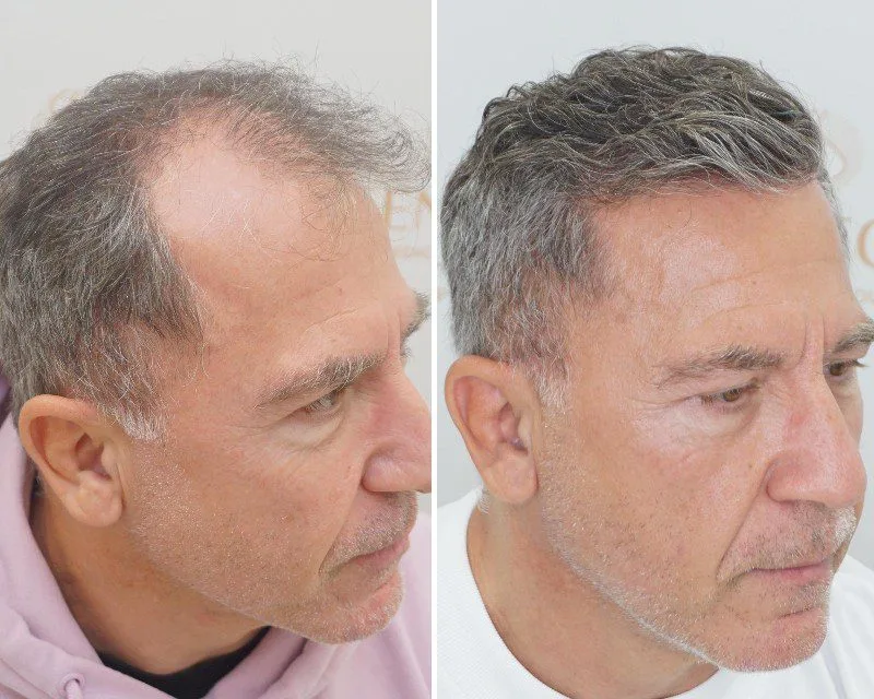 FUE by Doctor — Seneca Medical Group