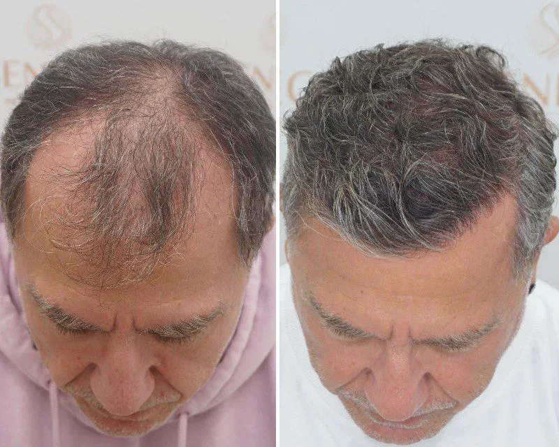 FUE by Doctor — Seneca Medical Group