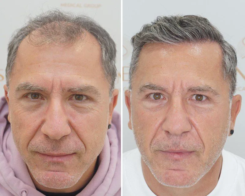 FUE by Doctor — Seneca Medical Group