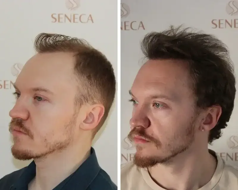 FUE by Doctor — Seneca Medical Group