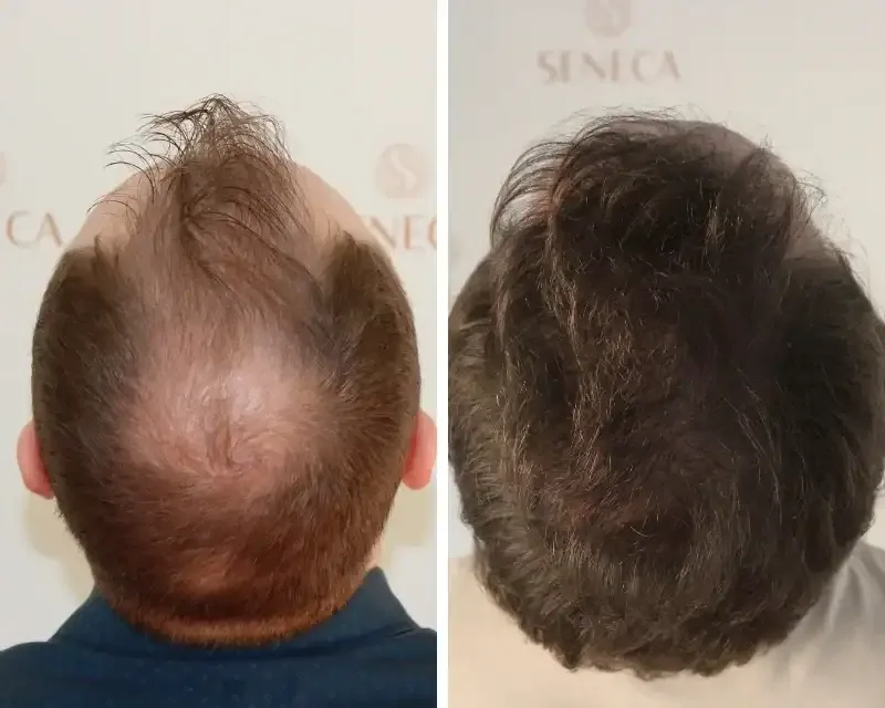 FUE by Doctor — Seneca Medical Group