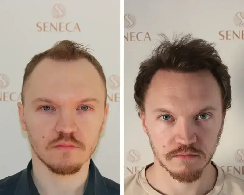 FUE by Doctor — Seneca Medical Group