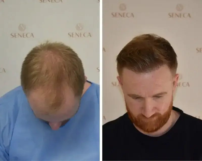 FUE by Doctor — Seneca Medical Group