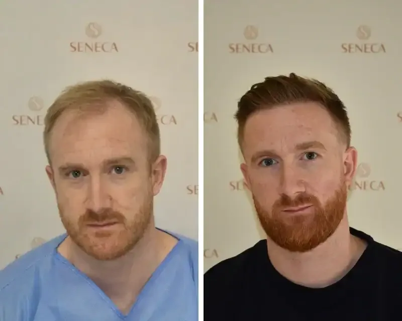 FUE by Doctor — Seneca Medical Group