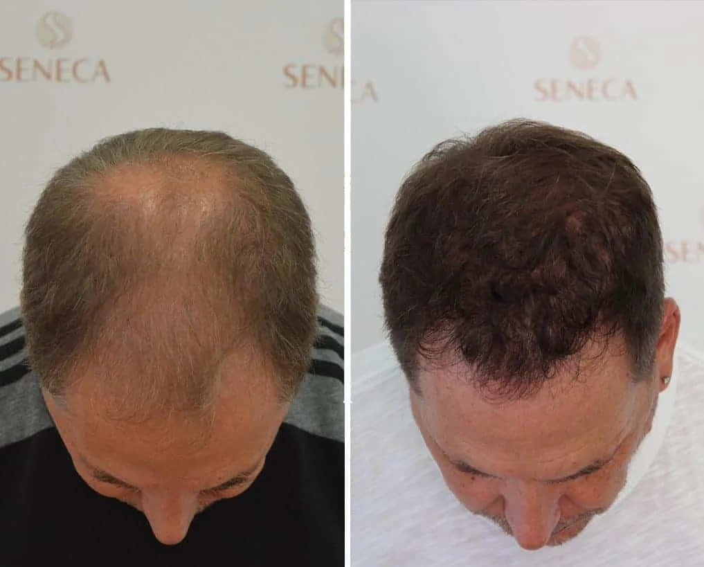 FUE by Doctor — Seneca Medical Group