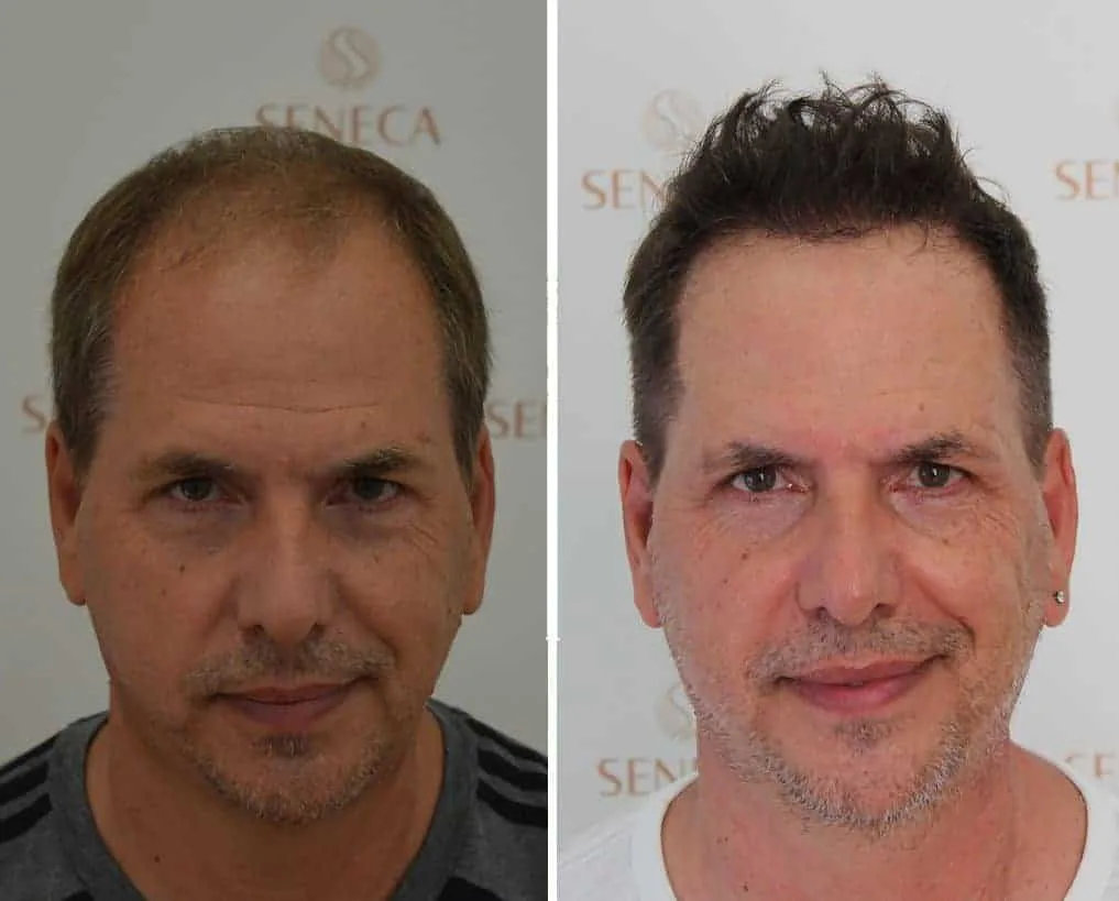 FUE by Doctor — Seneca Medical Group