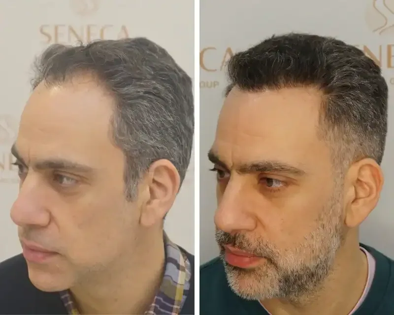 FUE by Doctor — Seneca Medical Group