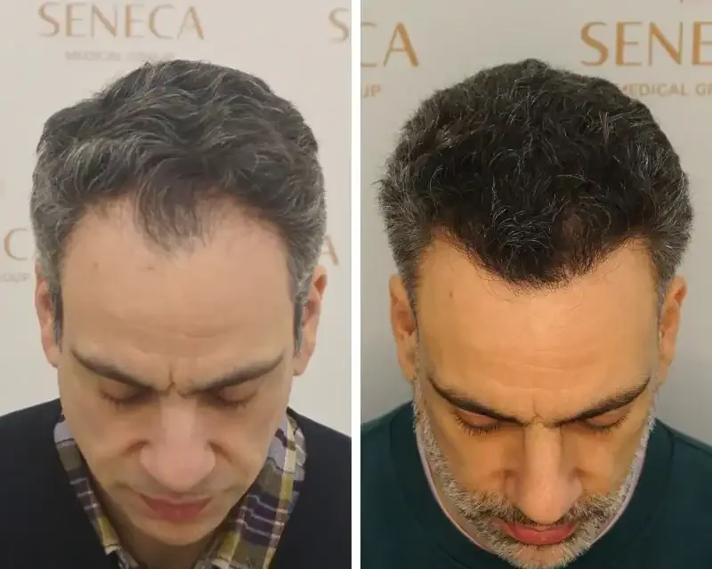 FUE by Doctor — Seneca Medical Group