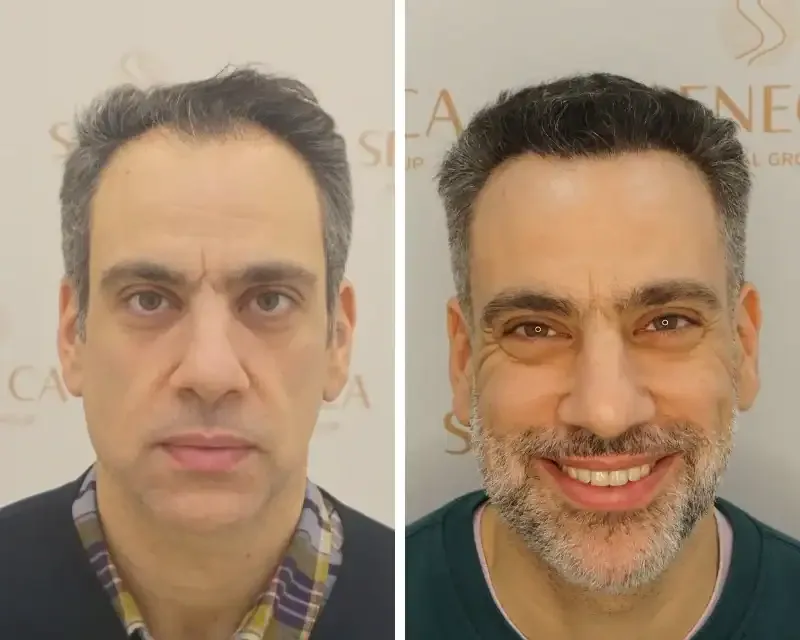 FUE by Doctor — Seneca Medical Group