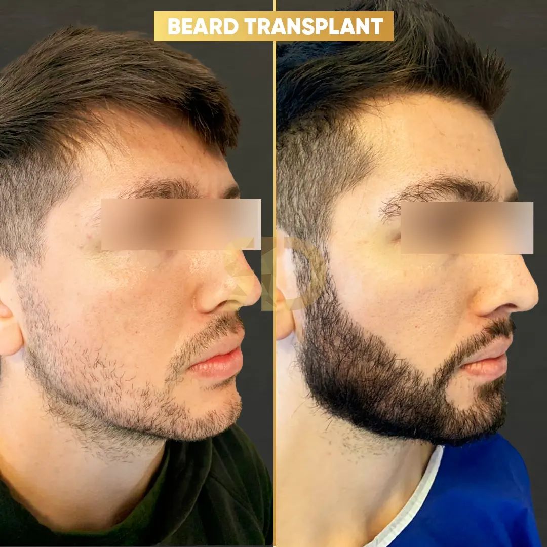 Beard Transplant — Dr Ergin Er - FUE & DHI team