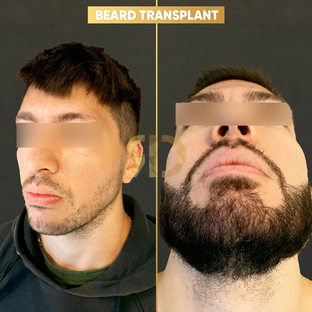 Beard Transplant — Dr Ergin Er - FUE & DHI team