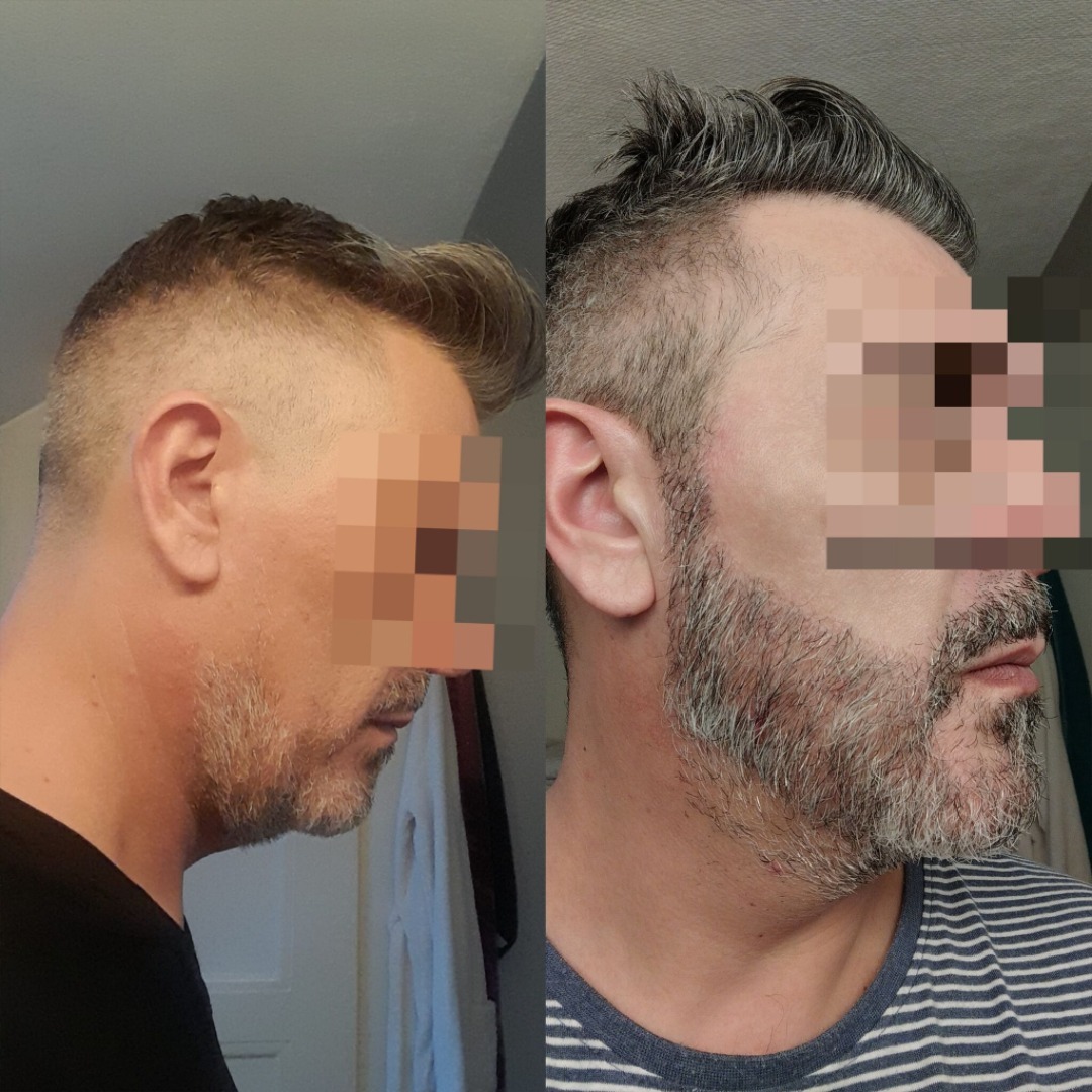 Beard Transplant — Dr Ergin Er - FUE & DHI team