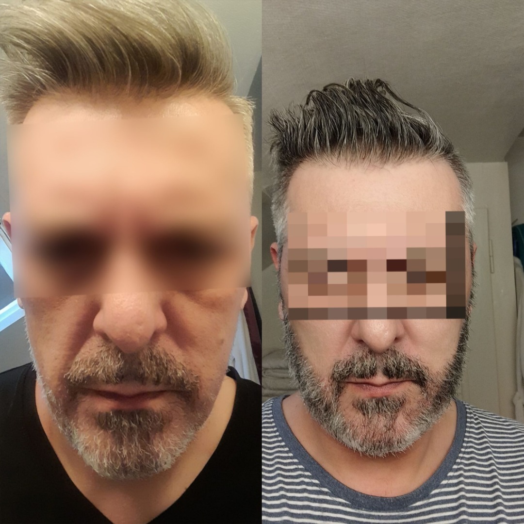 Beard Transplant — Dr Ergin Er - FUE & DHI team