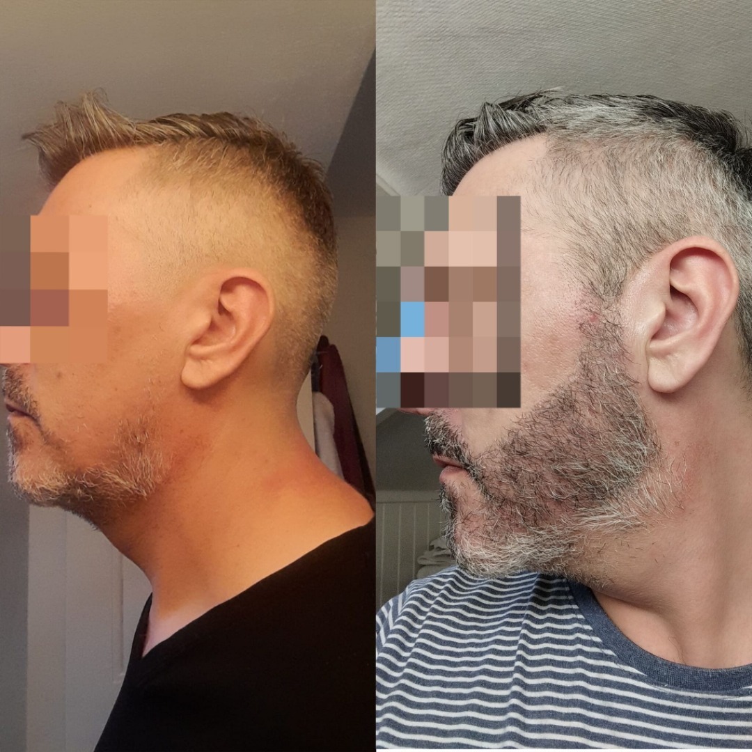 Beard Transplant — Dr Ergin Er - FUE & DHI team
