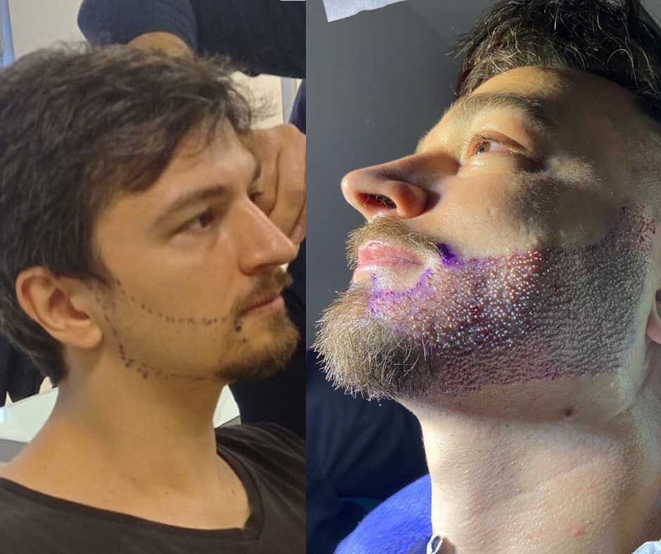 Beard Transplant — Dr Ergin Er - FUE & DHI team