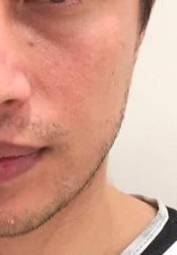 Beard Transplant — Hope Hair Health