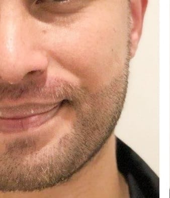 Beard Transplant — Hope Hair Health