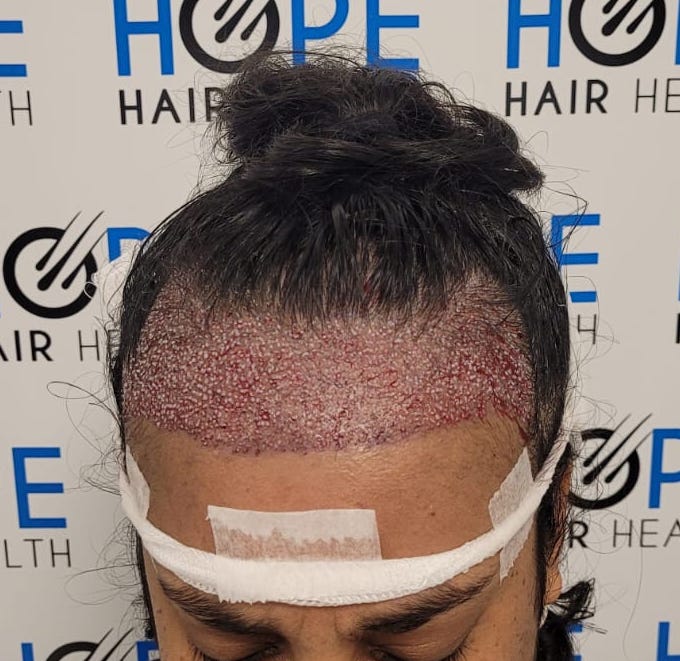FUE — Hope Hair Health