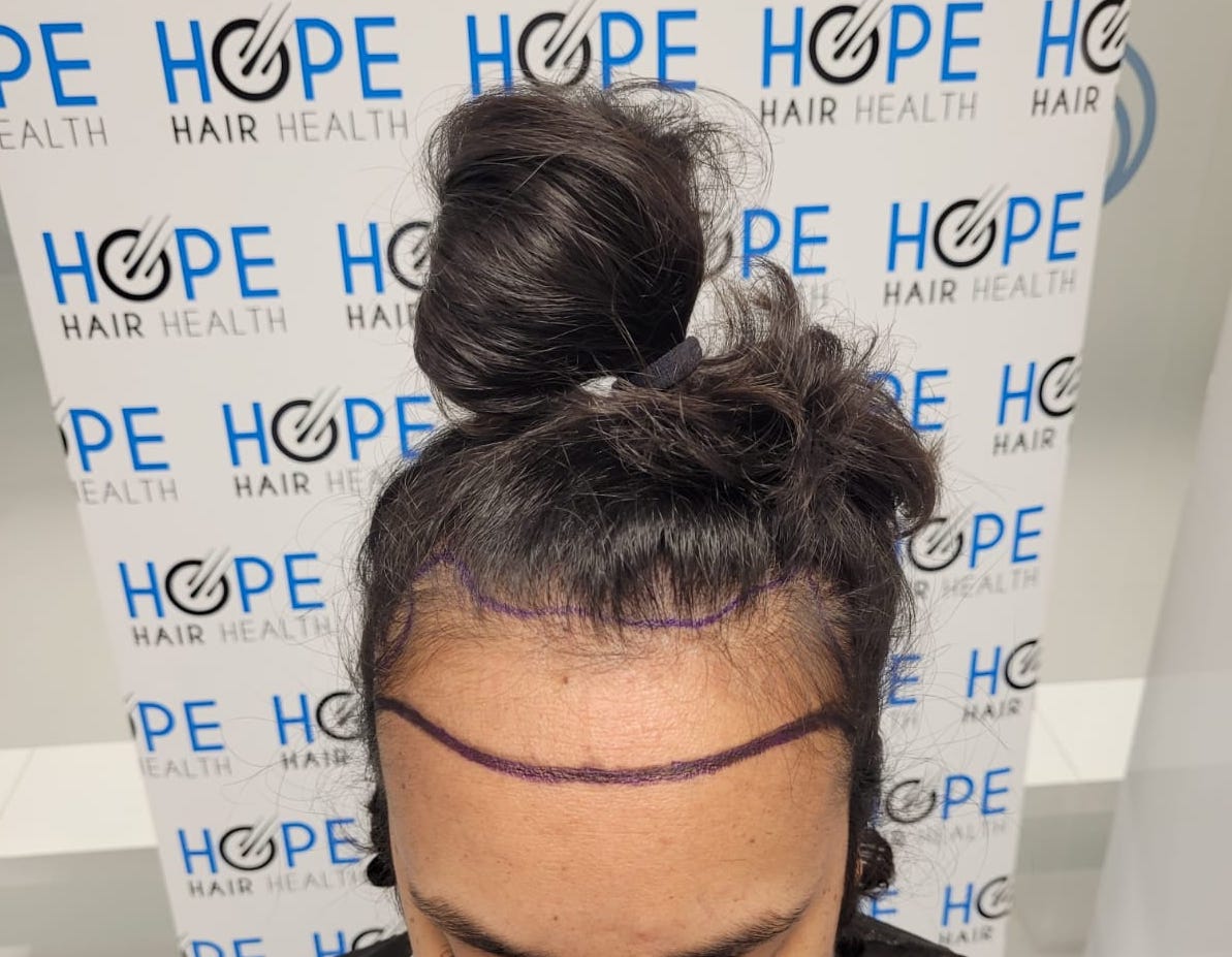 FUE — Hope Hair Health