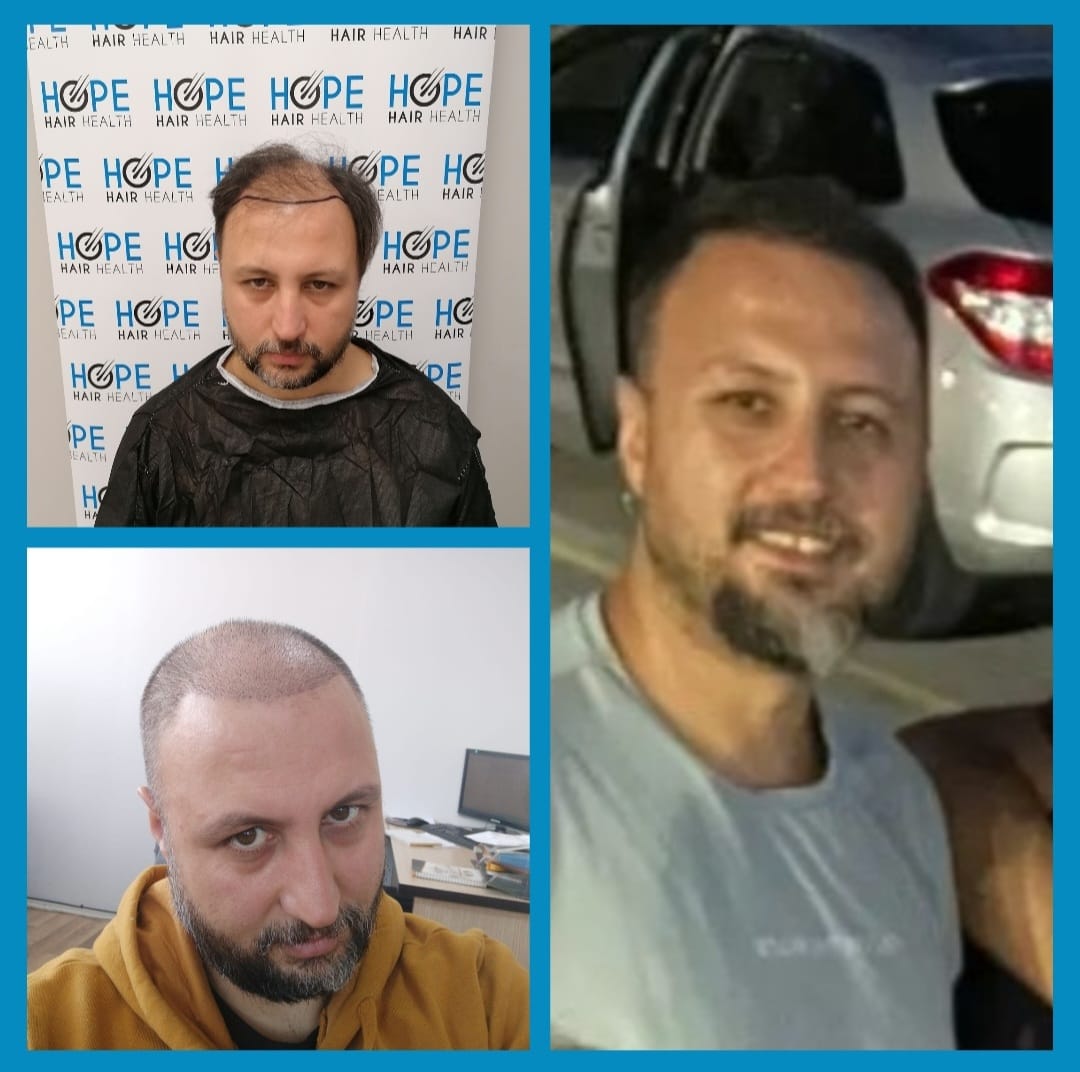 FUE — Hope Hair Health