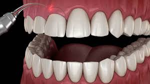 Gum contouring gum lift before and after